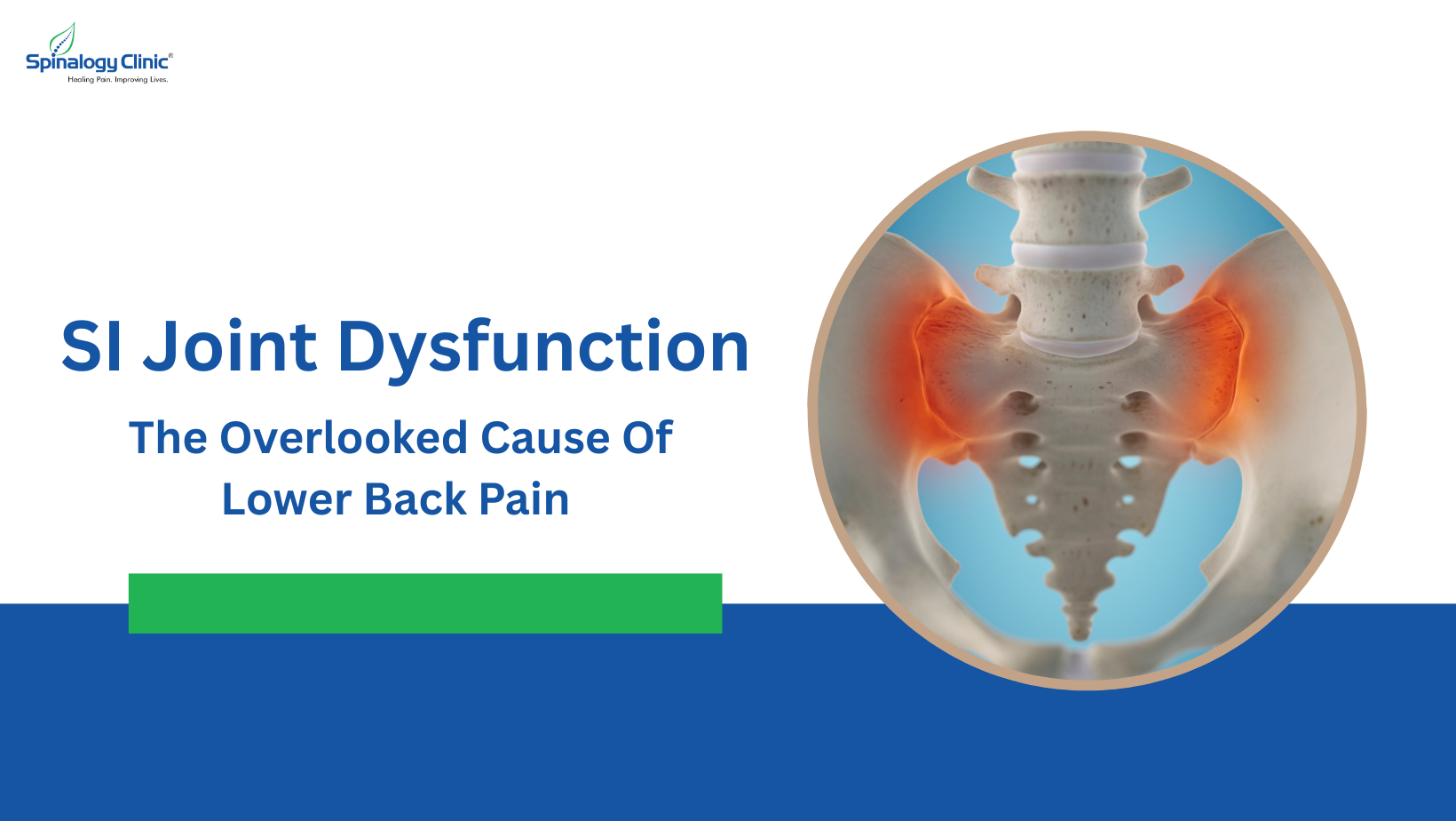 SI Joint Dysfunction: The Overlooked Cause of Lower Back Pain